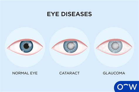 V SURGERY VTV SKY 777 ON EYE DISEASES 27 DEC 2018 .